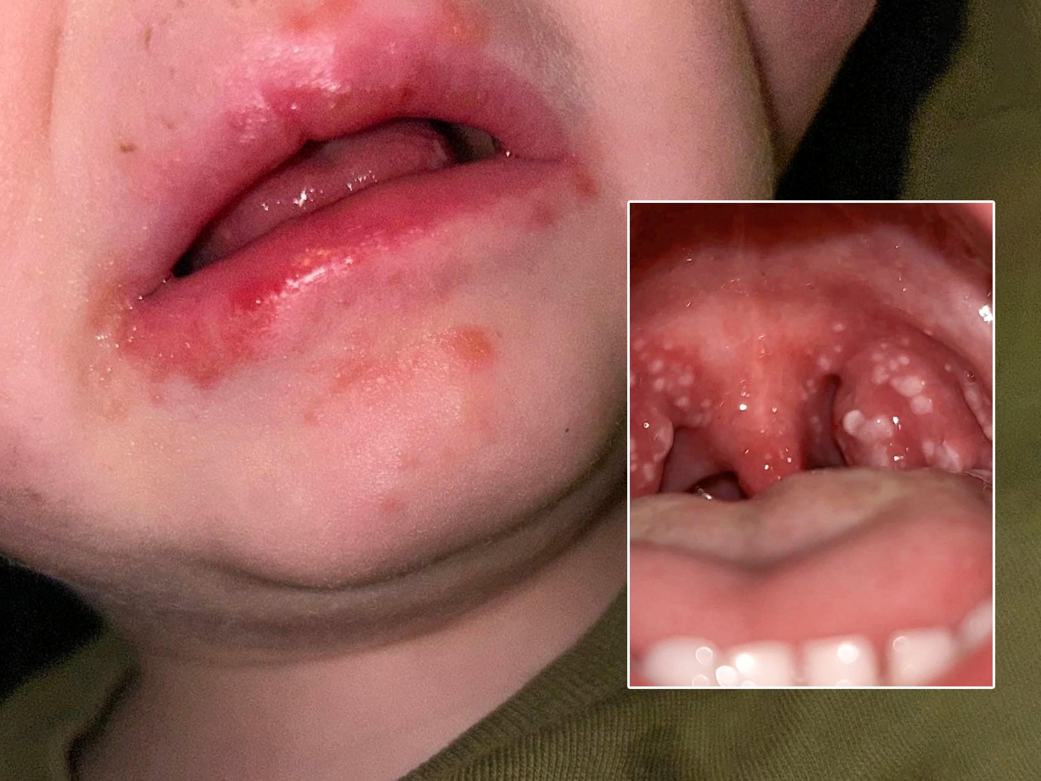 Is Strep Dangerous For Babies